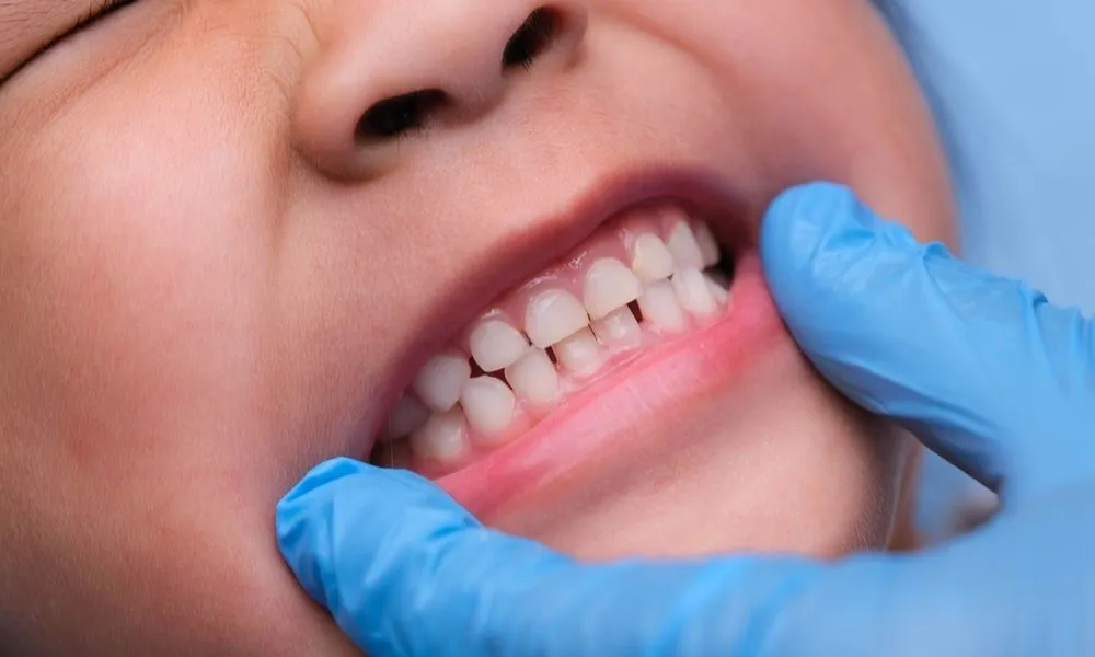 Vaikų dantukų gydymas su Domus Dentes 1 vaiku-dantuku-gydymas-su-domus-dentes