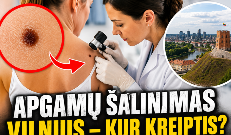 Apgamų šalinimas Vilnius — kur kreiptis dėl konsultacijos?